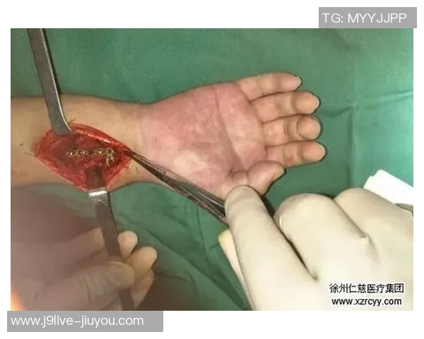 国米官方宣布迪詹纳罗右手腕骨折即将接受手术治疗 国米官方宣布迪詹纳罗右手腕骨折即将接受手术治疗